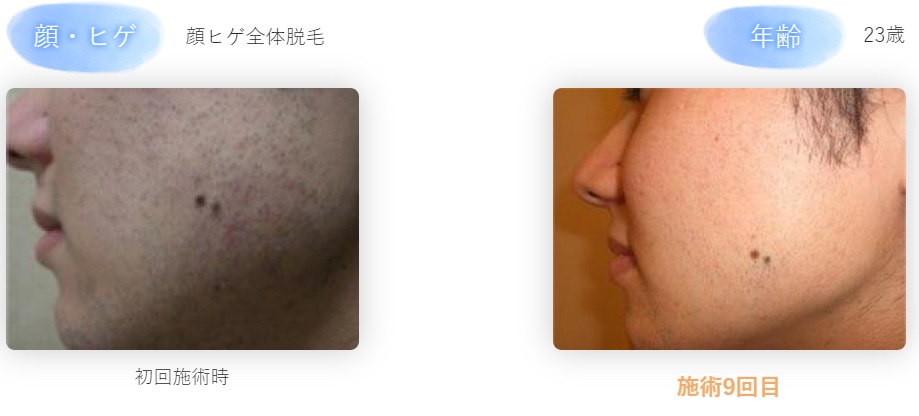 毛周期を知れば効率的に脱毛できる！毛周期の期間を部位別に解説