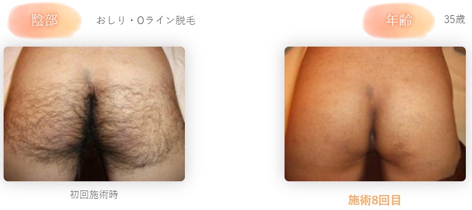 毛周期を知れば効率的に脱毛できる！毛周期の期間を部位別に解説