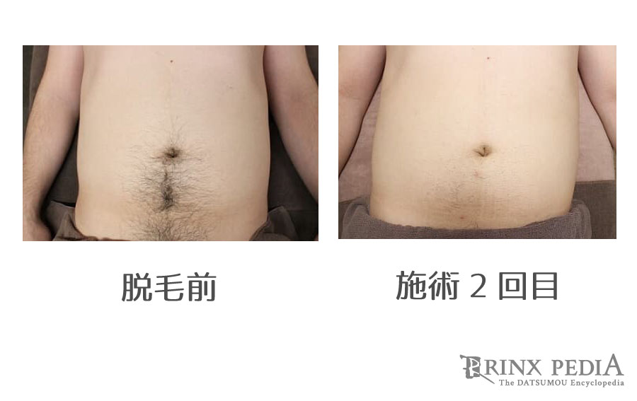 お腹の毛が濃い原因と取るべき対策