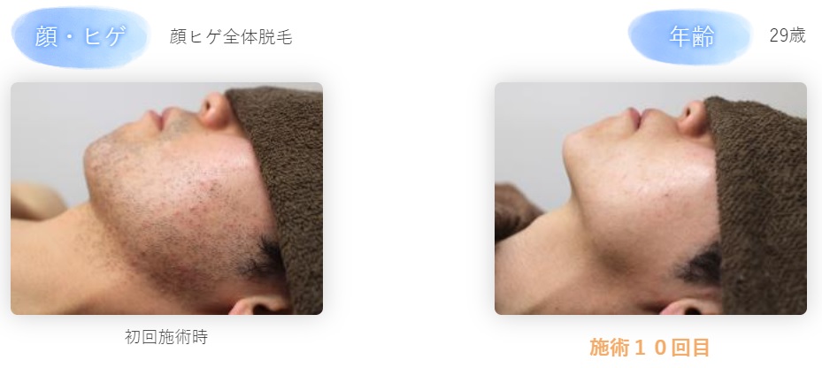 メンズ脱毛・ヒゲ脱毛の種類を総解説！効果や特徴の違いまとめ