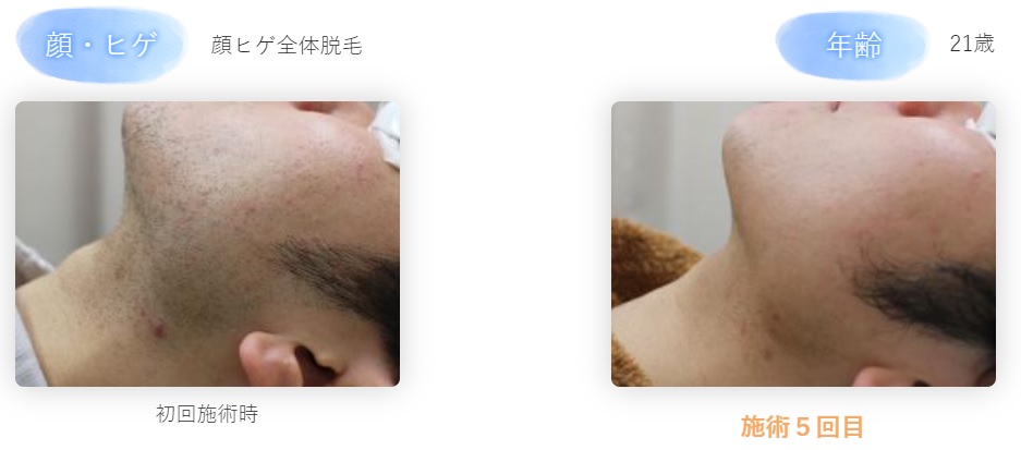 メンズ脱毛・ヒゲ脱毛の種類を総解説！効果や特徴の違いまとめ