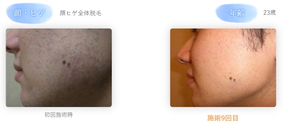 メンズ脱毛・ヒゲ脱毛の種類を総解説！効果や特徴の違いまとめ