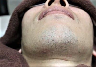 濃いヒゲを薄くする方法は？青髭対策は生活習慣の改善からヒゲ脱毛おすすめ！