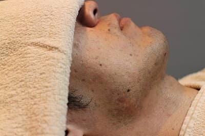 濃いヒゲを薄くする方法は？青髭対策は生活習慣の改善からヒゲ脱毛おすすめ！