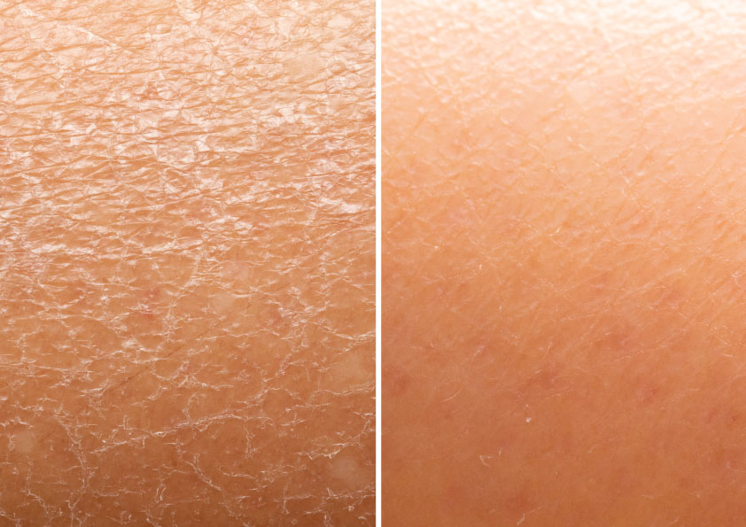 カミソリ負け 原因