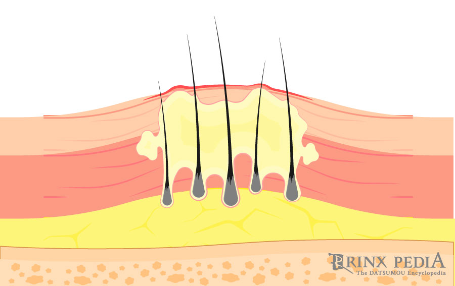 毛嚢炎の原因と正しい予防の方法 メンズ脱毛百科事典 リンクスペディア