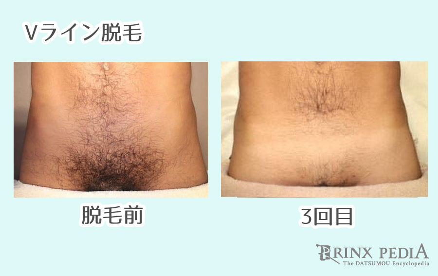 メンズ脱毛・永久脱毛で効果が出る回数や期間を部位別に解説