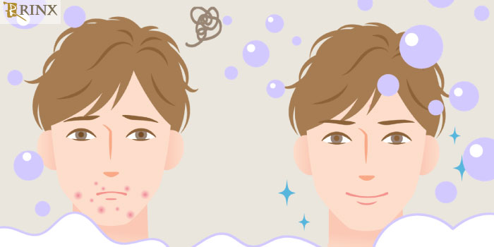 ヒゲ剃りで顔にニキビができる？！顔のニキビの原因と予防・改善方法を解説