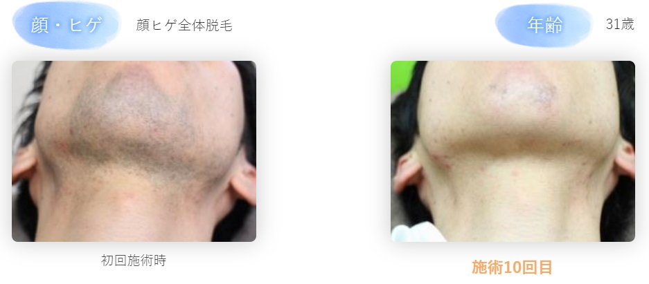 剃り残しの原因とヒゲをキレイに剃るためのポイントを解説