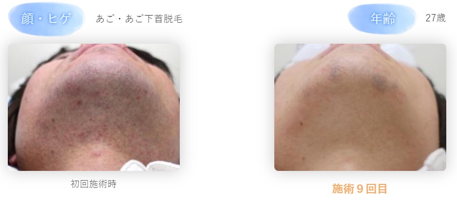 剃り残しの原因とヒゲをキレイに剃るためのポイントを解説