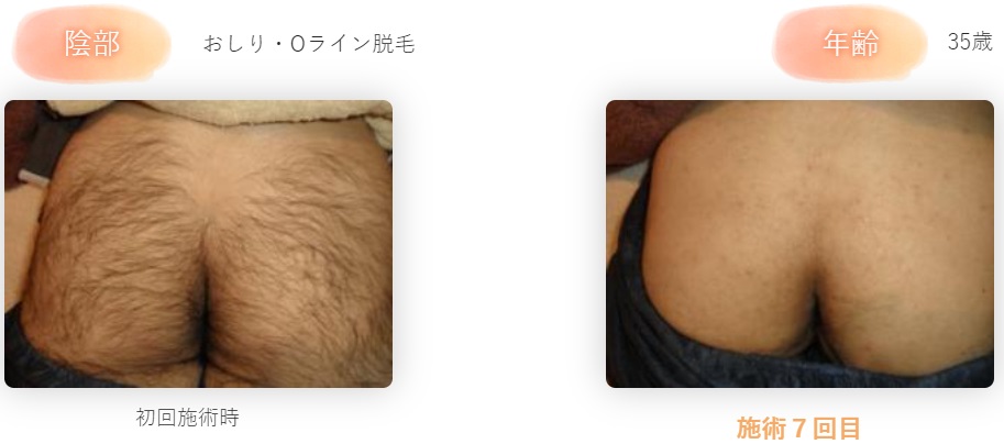 陰毛が濃い男性の印象は?陰毛が濃くなる原因とおすすめの処理方法を解説