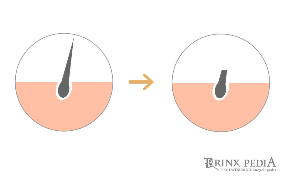 毛が濃くなる理由は？自宅でできる対策や脱毛について解説