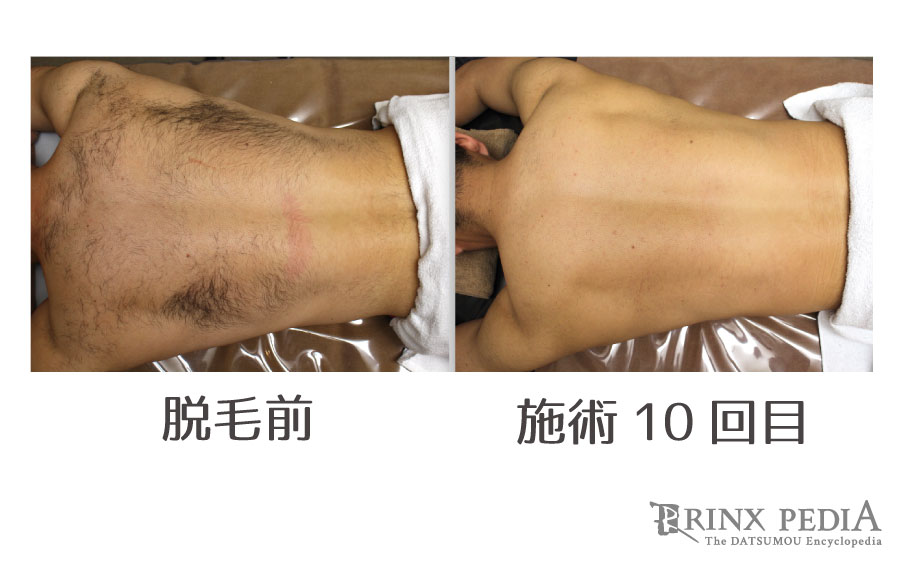 男の肩毛どう処理する?肩毛が生える原因とおすすめ対策法