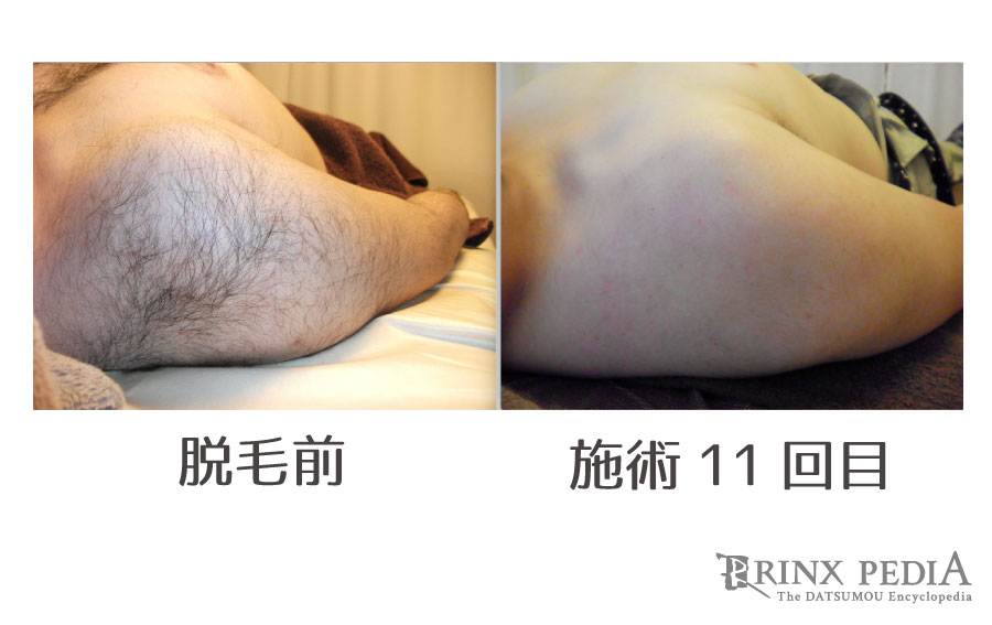 男の肩毛どう処理する？肩毛が生える原因とおすすめ対策法