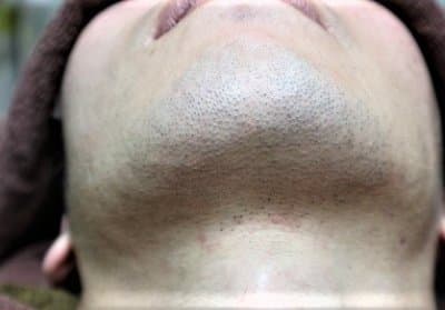 ヒゲ脱毛の効果は何回で出る？回数の目安や効率的に脱毛する方法を解説