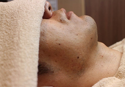 ヒゲ脱毛の効果は何回で出る？回数の目安や効率的に脱毛する方法を解説