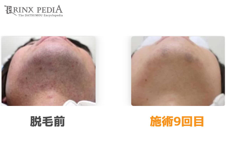 ヒゲの剃り残しを抜くのはng アゴ下や首をキレイに剃る方法を解説 メンズ脱毛百科事典 リンクスペディア