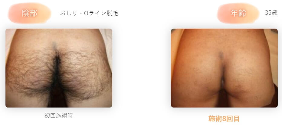 メンズ脱毛は恥ずかしい?実際の流れや体勢を解説