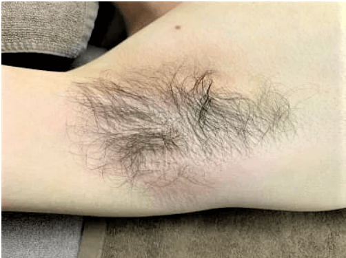 男の脇毛どうすればいい?女性の本音と脇毛の自己処理と脱毛について解説