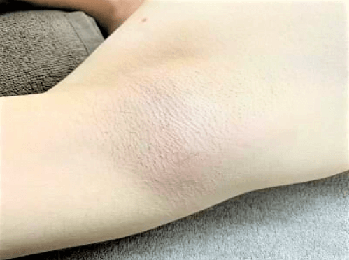 男の脇毛どうすればいい?女性の本音と脇毛の自己処理と脱毛について解説