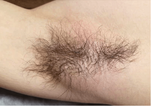 男の脇毛どうすればいい?女性の本音と脇毛の自己処理と脱毛について解説