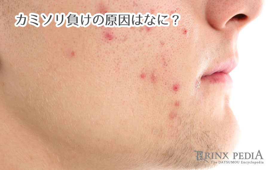 カミソリ負けにはどのような治療法が効果的ですか?