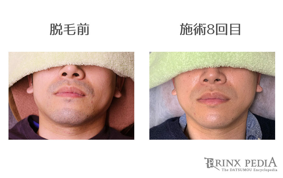 SHR脱毛とは？メンズ脱毛での効果やメリット・デメリットを解説