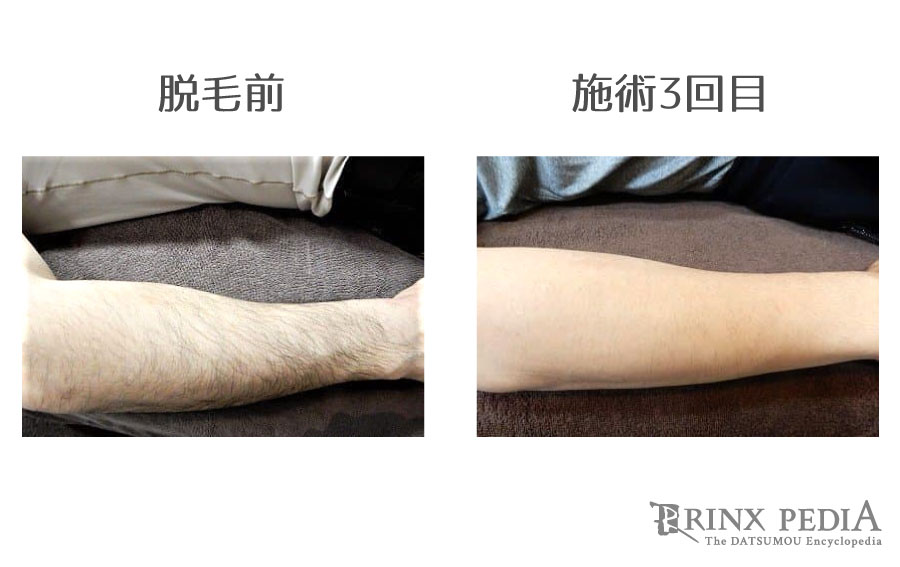 SHR脱毛とは？メンズ脱毛での効果やメリット・デメリットを解説