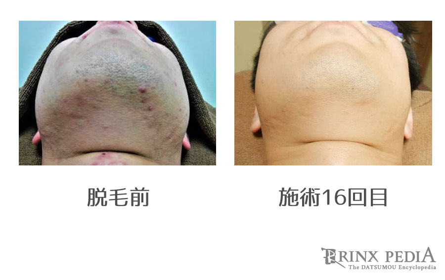 ヒゲ脱毛に美肌効果がある4つの理由！得られる美肌効果を部位別で解説！