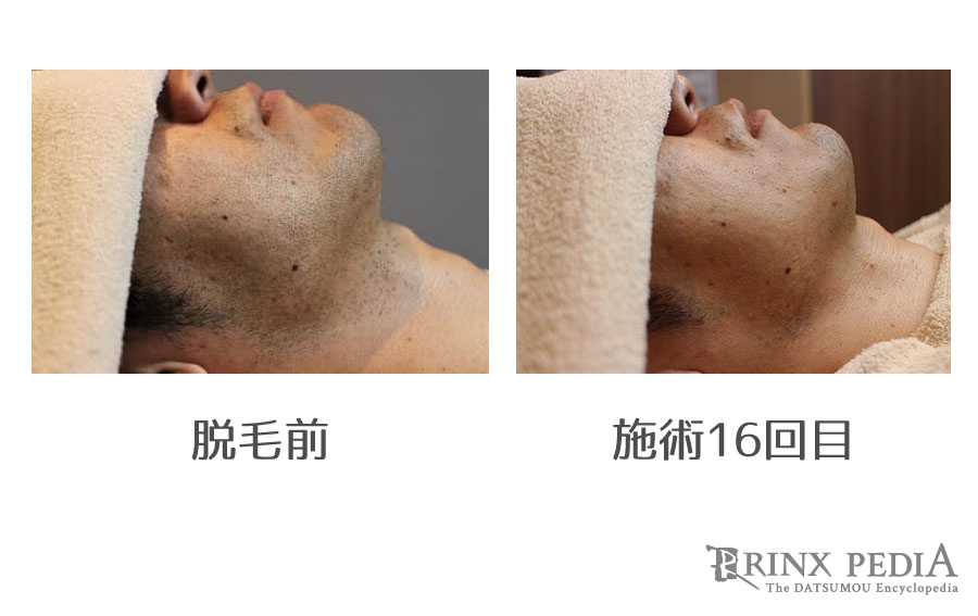 ヒゲ脱毛に美肌効果がある4つの理由!得られる美肌効果を部位別で解説!