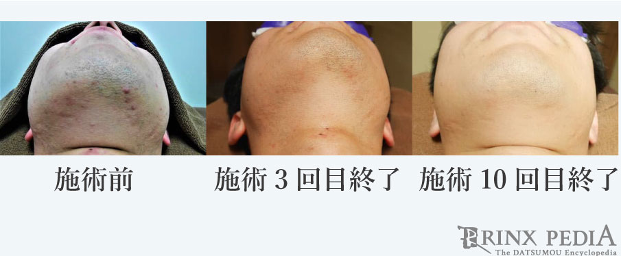 ヒゲ脱毛で後悔したくない!永久脱毛でよくある失敗を解説