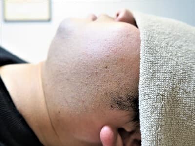 ヒゲ脱毛の経過写真