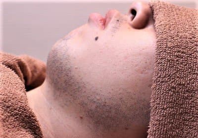 IPL脱毛はヒゲ脱毛におすすめ！メリットとデメリットについて解説！