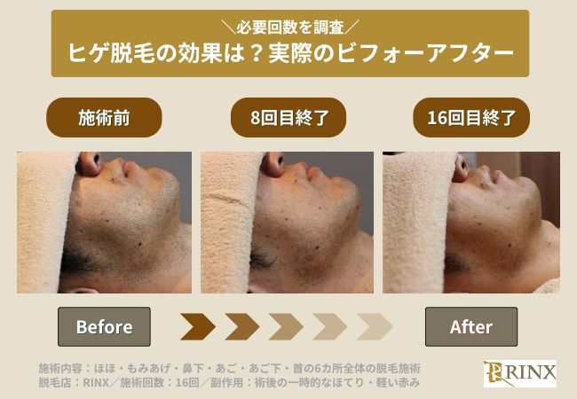 ヒゲ脱毛で実際に必要な回数を徹底検証するビフォーアフター