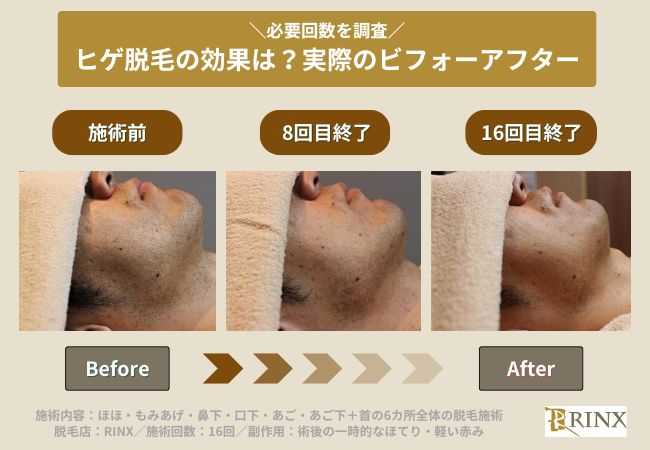 ヒゲ脱毛の効果のビフォーアフター