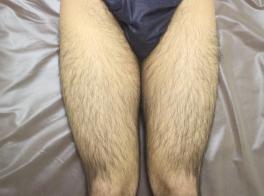 初回施術時の写真