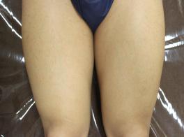 施術4回目の写真