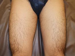 初回施術時の写真