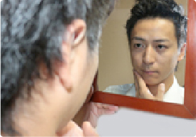 鼻下脱毛の完了写真