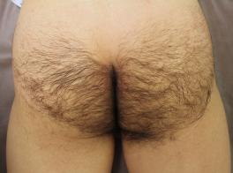 初回施術時の写真