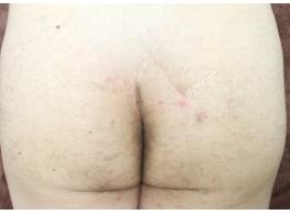 施術6回目の写真