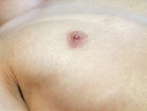 あご下・首ヒゲ脱毛の肌状のチェック写真