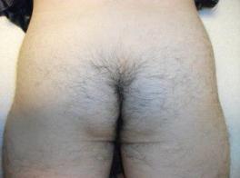 初回施術時の写真