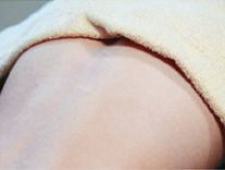 あご下・首ヒゲ脱毛の肌状のチェック写真