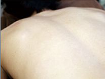 あご下・首ヒゲ脱毛の肌状のチェック写真