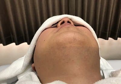 施術6回目